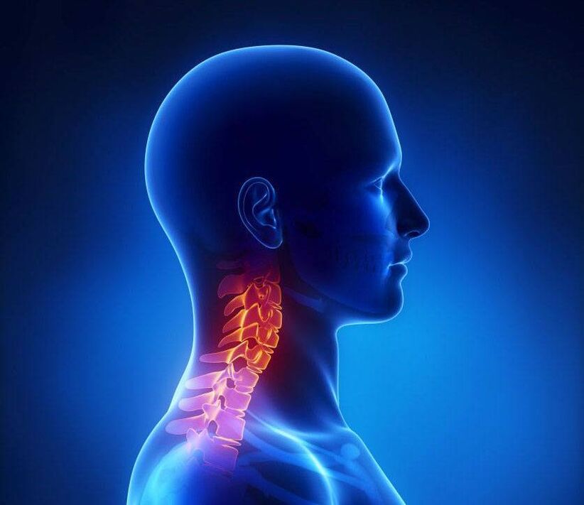 osteochondrosis pada tulang belakang leher