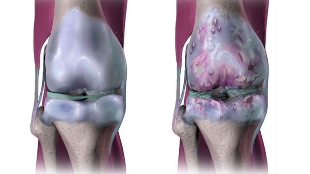 Sendi lutut yang sehat dan terkena artrosis