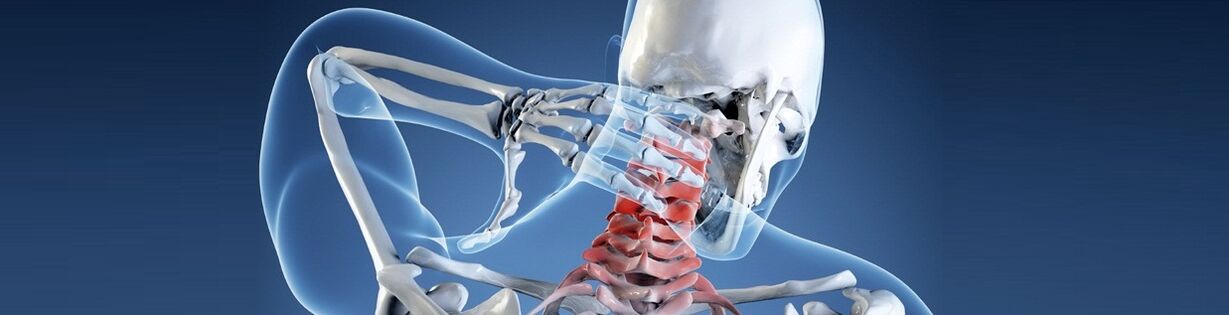 Osteochondrosis pada tulang belakang leher manusia