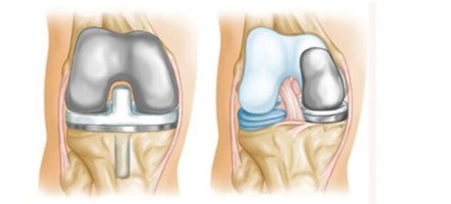 artroplasti untuk artrosis sendi lutut