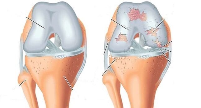 sendi yang sehat dan artrosis pada sendi lutut