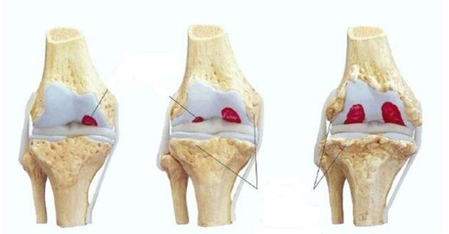 tahap arthrosis sendi lutut