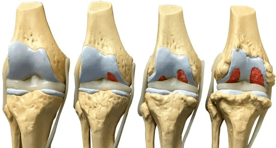kerusakan sendi lutut pada berbagai tahap perkembangan arthrosis