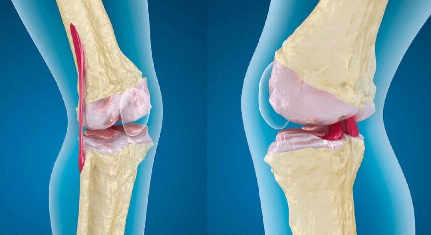 sendi yang sehat dan artrosis pada sendi lutut
