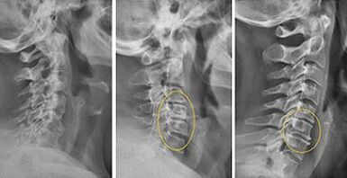 gambar tulang belakang leher untuk diagnosis