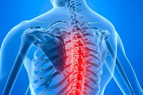 lesi tulang belakang dalam kasus osteochondrosis toraks