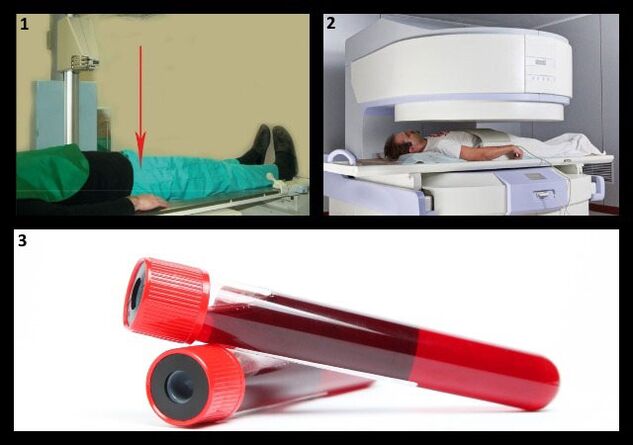 Metode untuk mendiagnosis coxarthrosis - X-ray dan MRI sendi panggul, tes darah