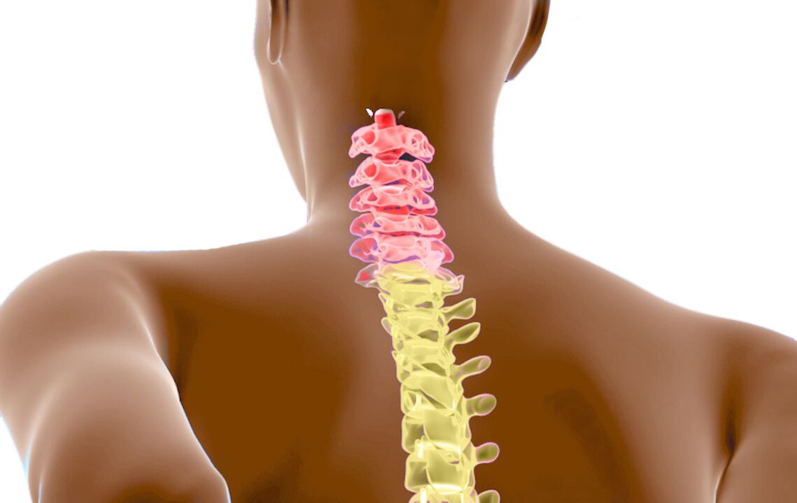 osteochondrosis tulang belakang leher
