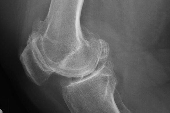 Metode untuk mendiagnosis arthrosis lutut