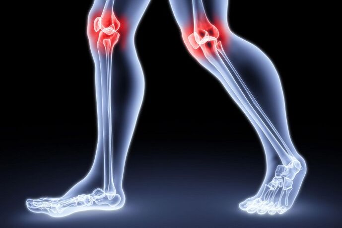 nyeri lutut karena arthritis dan arthrosis