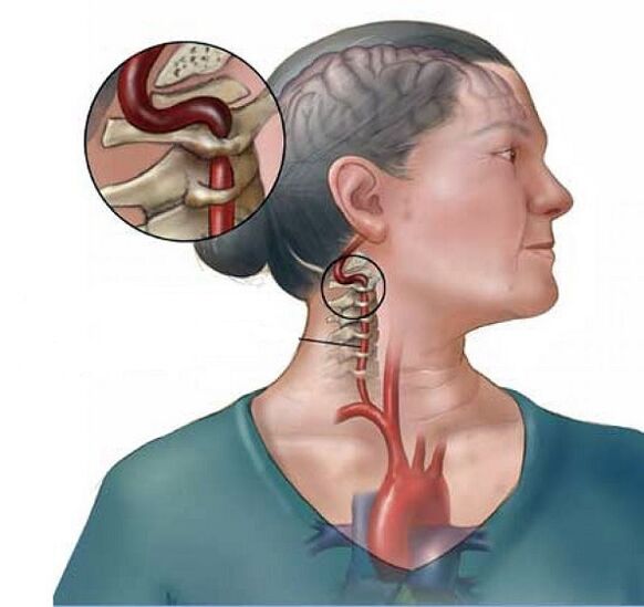 sindrom arteri vertebralis dengan osteochondrosis serviks