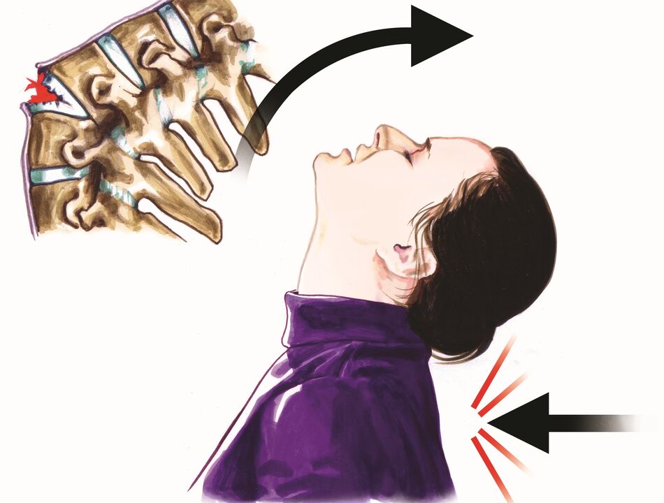 kerusakan tulang belakang sebagai penyebab nyeri leher