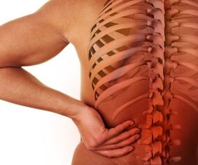 nyeri punggung dengan osteochondrosis lumbal