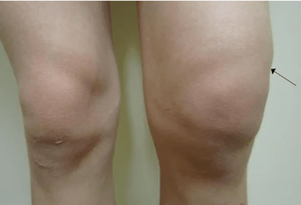 Hemarthrosis pada sendi lutut