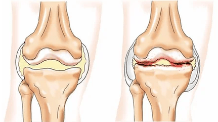 kondromatosis